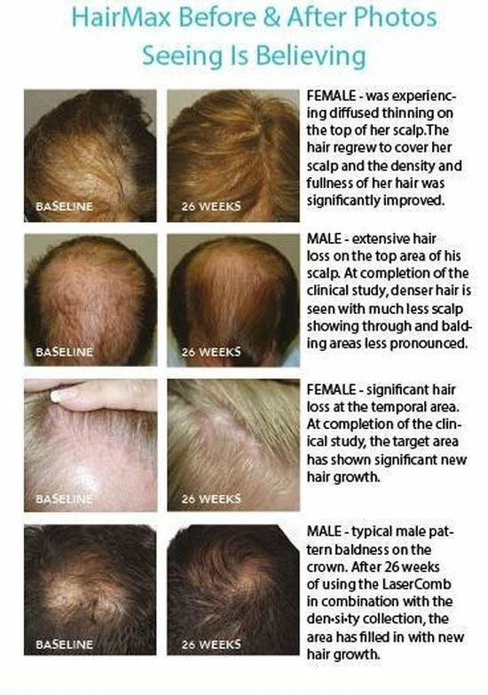 HairMax Laserband 82 - Afbeelding 12